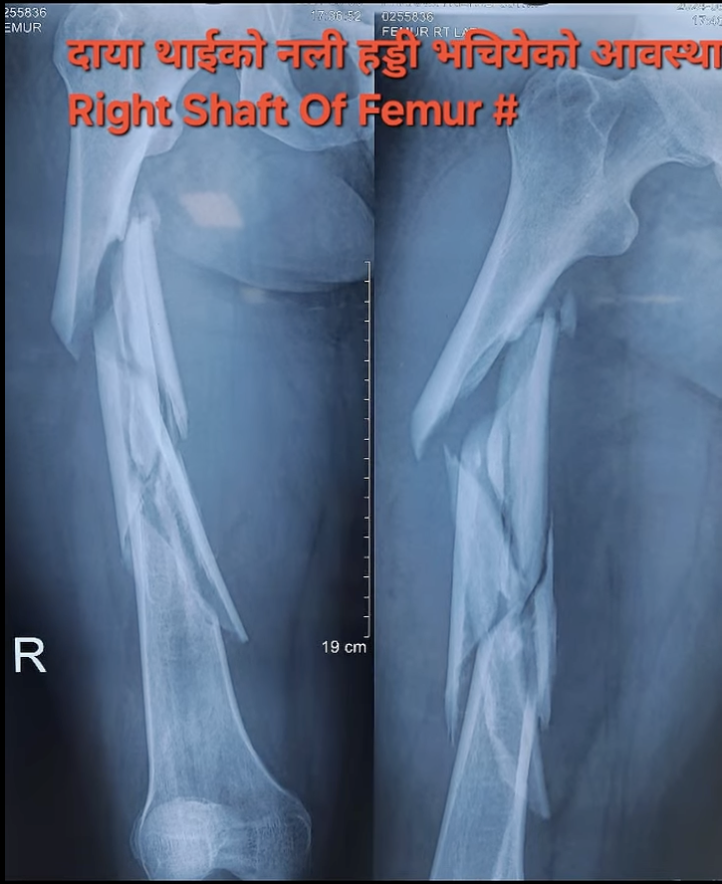 थाईको हड्डी (Femur Shaft) भाँचिएको केस: बाइक दुर्घटनापछि सफल शल्यक्रिया