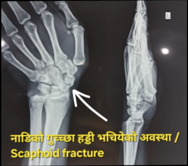 Scaphoid Fracture: A Delayed Case Managed with Surgical Fixation